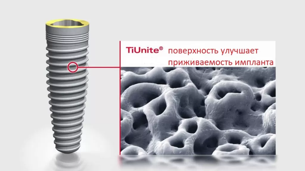 Уникальная поверхность импланта - TiUnite, которая открыла дорогу одноэтапной имплантации с немедленной нагрузкой